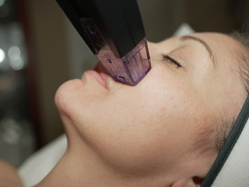 A woman receiving a Morpheus8 treatment on her face