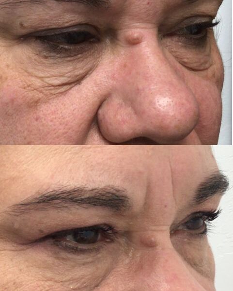 Before and after Morpheus8 eye treatment