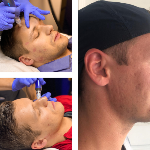 Three Photos depitic before and after treatment of a male patient with microneedling.