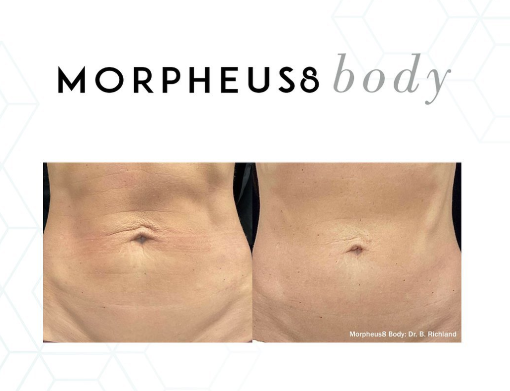 Before and After photo of Morpheus8 belly treatment