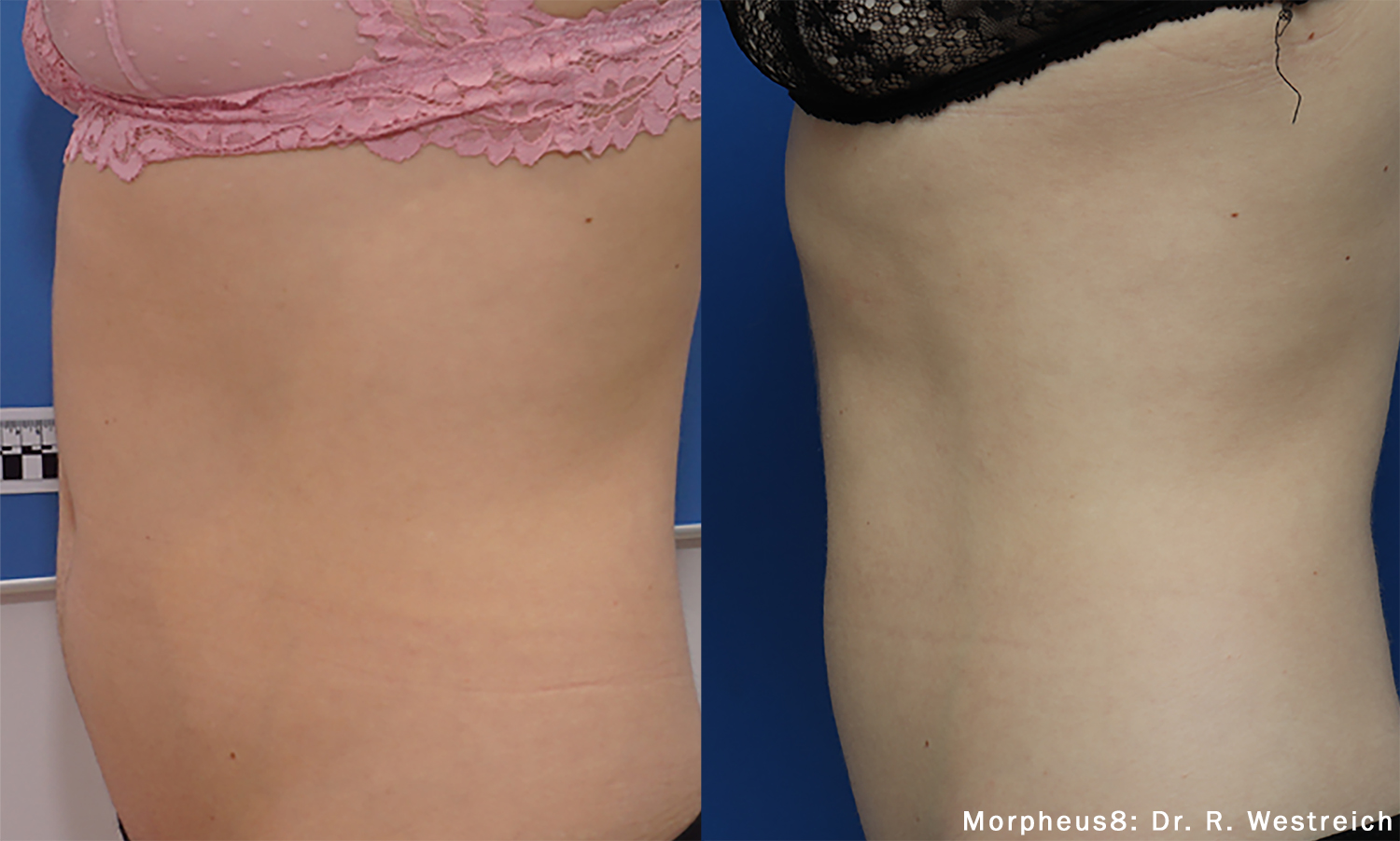 Before and after photo of morpheus8 stomach treatment