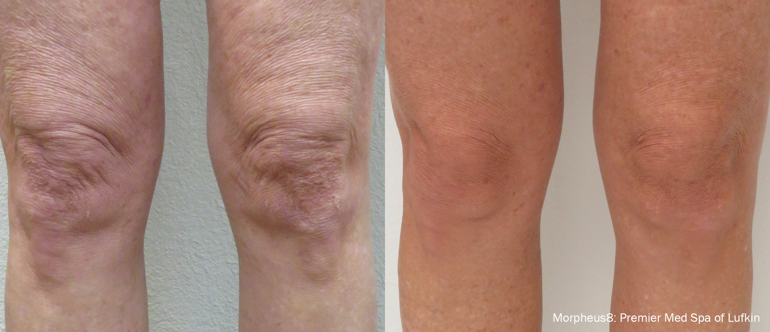 Before and after photo of morpheus8 leg treatment