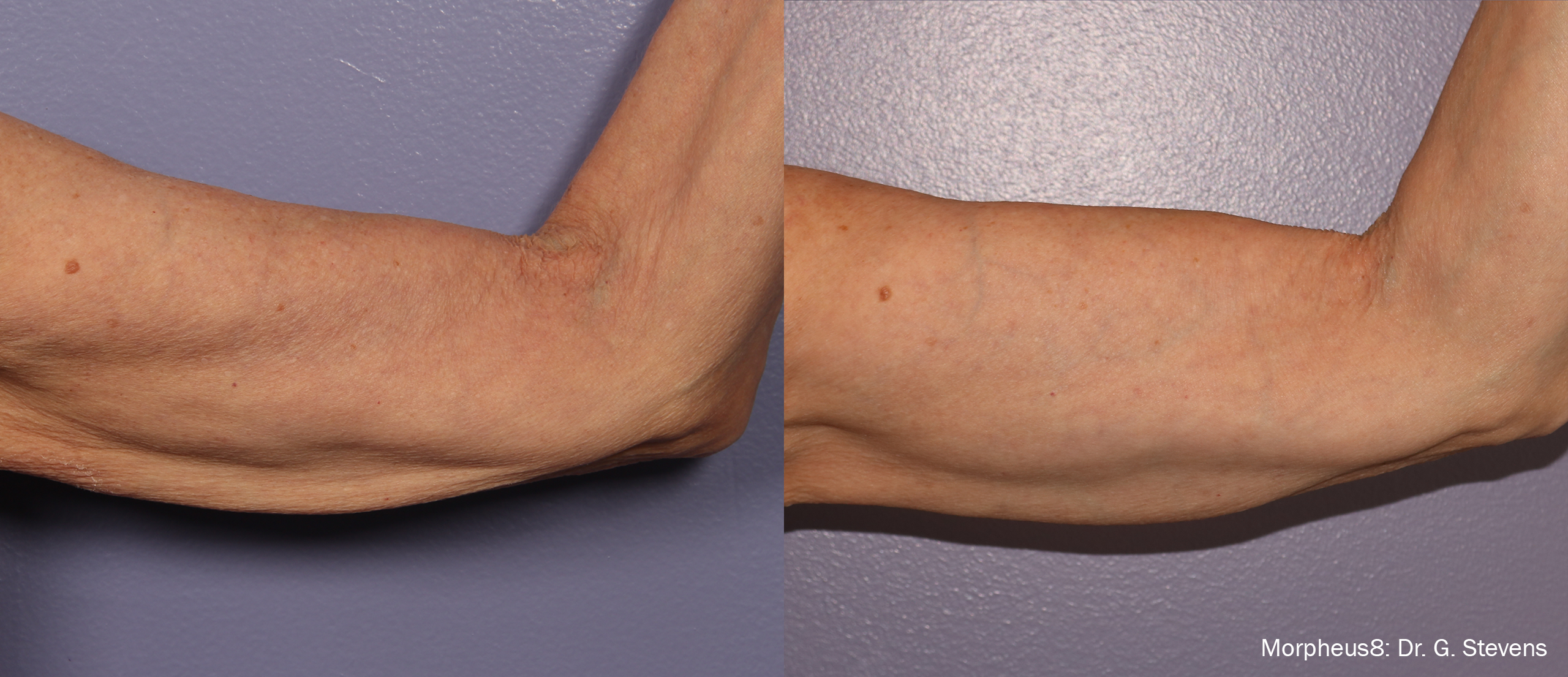 Before and after photo of morpheus8 arm treatment