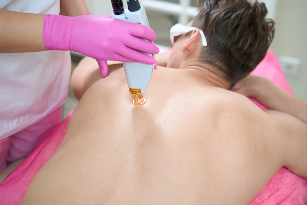 A men gets unwanted hair removed from his back with laser hair removal